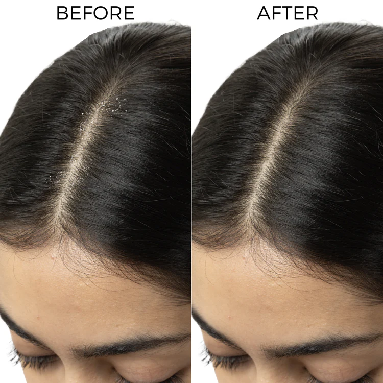 Lactylate & Piroctone Olamine Scalp Serum for Dandruff Control - Image 3