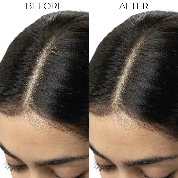 Dandruff Control Shampoo For Itchy, Flaky Scalp - Image 4