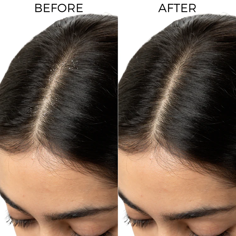 Lactylate Shampoo To Reduce Dandruff - Image 6